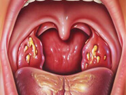 amandelstenen-tonsilstones