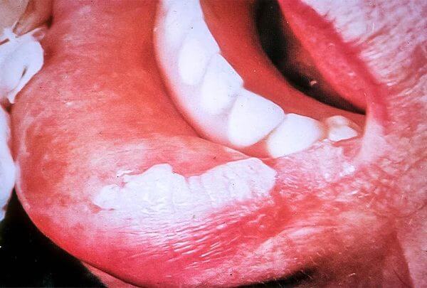 orale leukoplakie