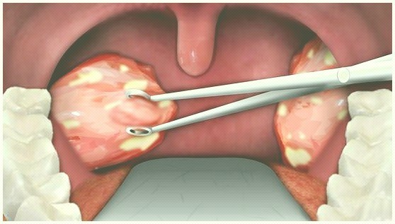 tonsillectomie