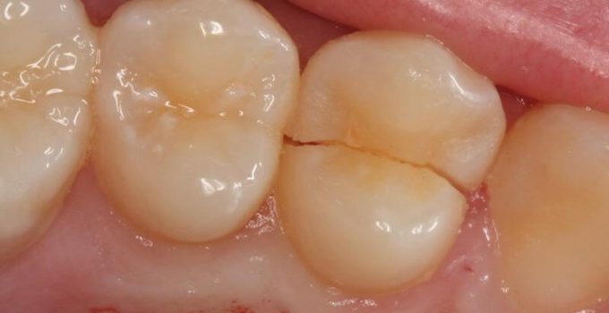 cracked tooth