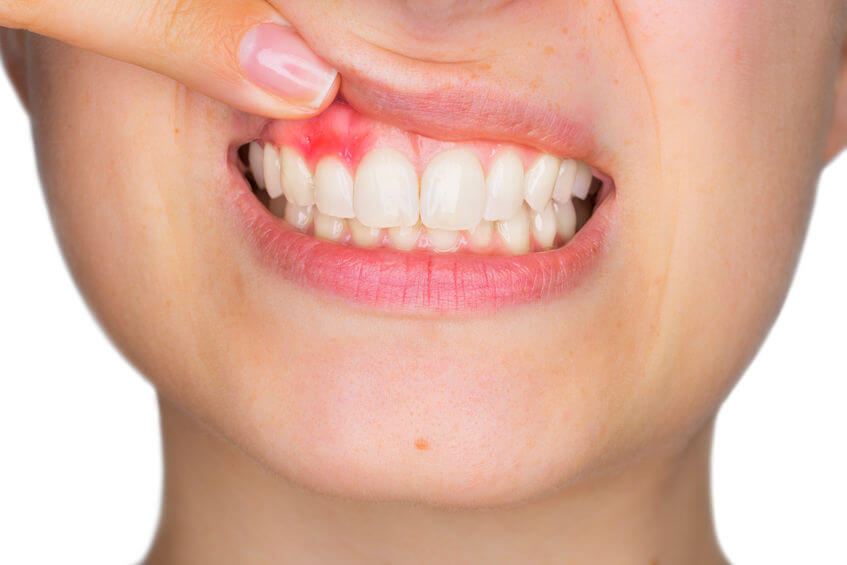 parodontitis oorzaak