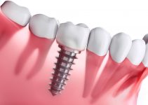 implantaten gebit