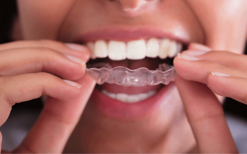 Voor- en nadelen Invisalign