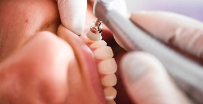 Is gebitsreiniging een behandeling?